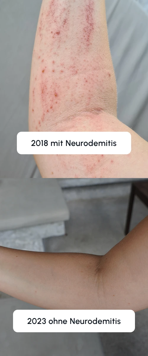 Neurodermitis Selbstheilung Für Selbstbetroffene Kristin 2