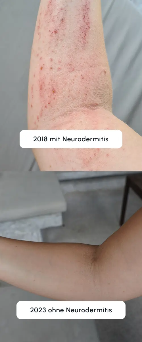 Neurodermitis-Selbstheilung-Fuer-Selbstbetroffene-Kristin-2-1