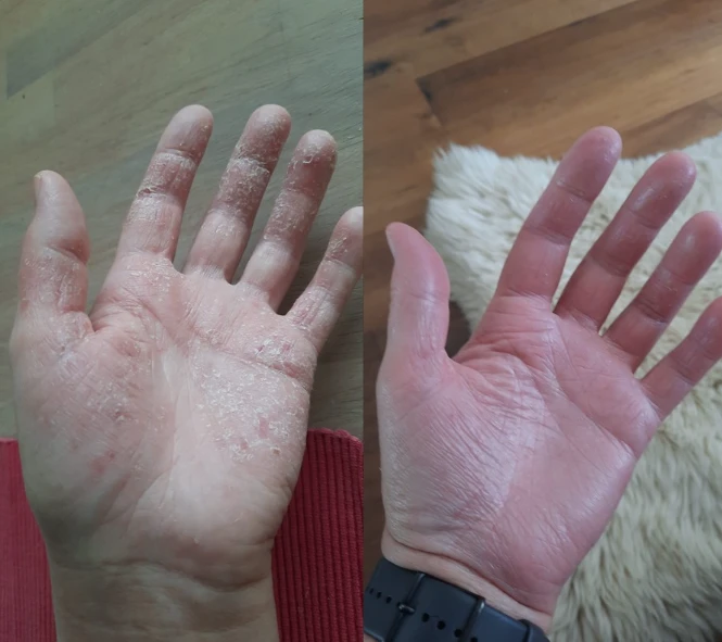 Vorher Nachher Hand Andrea Hartmann